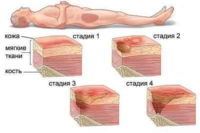 Пролежни: симптомы, причины, стадии, профилактика и лечение в домашних  условиях у лежачих больных