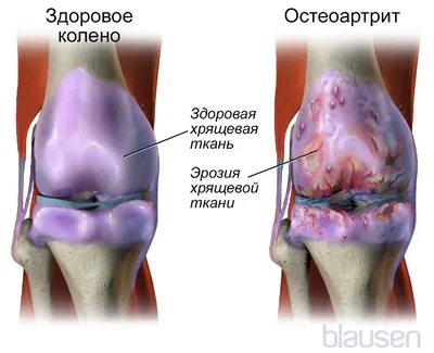 Пролежни лечение – лучшие средства от пролежней: противопролежневые  матрасы, мази от пролежней, повязки и пластыри. +7 (495) 789-42-03.  Доставка.