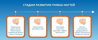 Причины, симптомы и лечение грибковой инфекции: чем лечить микоз ногтей и  кожи