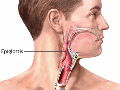 Воспаление надгортанника. Эпилглотит. | ЛОР КЛИНИКА ЗАЙЦЕВА | Дзен