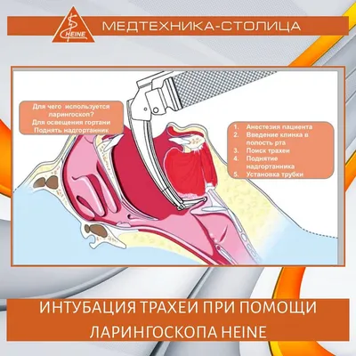 Беспокоит надгортанник - Вопрос лору - 03 Онлайн