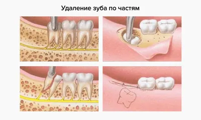 После удаления зуба остался кусочек, осколок в десне — что делать, если  вырвали зуб без корня