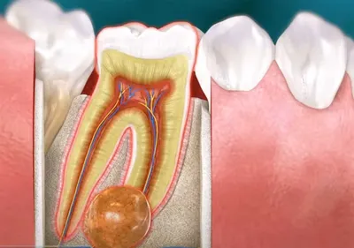 ᐈ Удаление Зуба: Как Предотвратить Осложнения ᐈ Возможные последствия после  удаления зуба