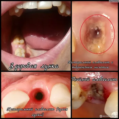 Сколько ждать после удаления зуба, чтобы установить имплантат? |  Стоматологическая клиника доктора Олега Курова | Дзен