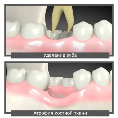 Сколько ждать после удаления зуба, чтобы установить имплантат? |  Стоматологическая клиника доктора Олега Курова | Дзен