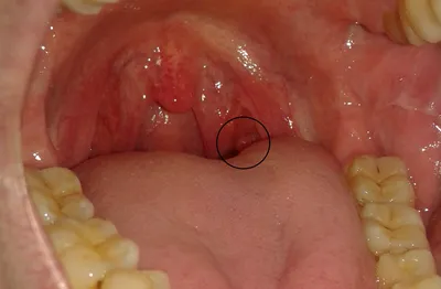 Непонятный нарост на миндалине - Вопрос лору - 03 Онлайн