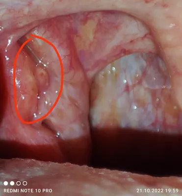 Нарост на миндалине, что это? Обнаружила такой нарост на гланде ( за  пленочкой | MedAboutMe