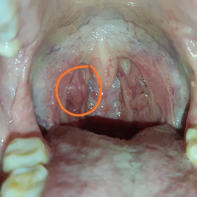 Нарост на миндалине при храническом тонзиллите - Вопрос лору - 03 Онлайн