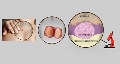 Фиброма - причины появления, симптомы заболевания, диагностика и способы  лечения