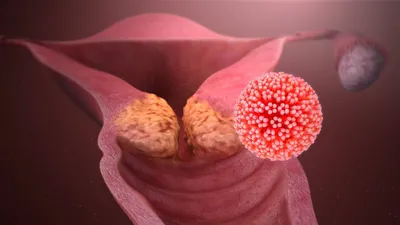Рак ануса: онкология анального канала первые симптомы, лечение рака заднего  прохода | Клиники «Евроонко»