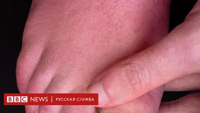 Наросты на костяшках пальцев рук: причины, симптомы и методы лечения