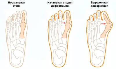 Лечение вальгусной деформации в Киеве цена, отзывы | Цертус ᐈ Certus |  Certus