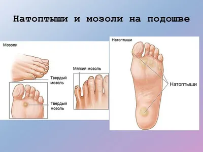 Мозоли и натоптыши на ногах. Как от них избавиться?