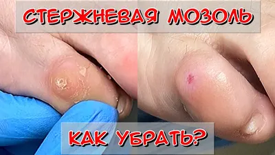 Стержневая мозоль: что это такое и как с ней бороться?