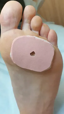 Removal of callus - YouTube