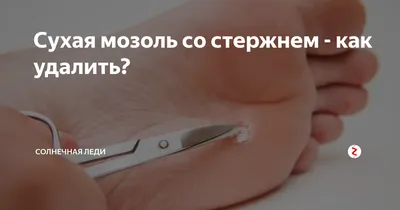 Что такое мозоль и как от неё избавиться — блог медицинского центра ОН  Клиник