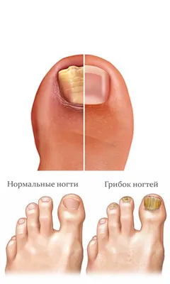 Негрибковые заболевания ногтей | ВКонтакте