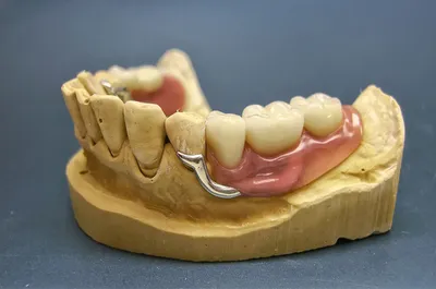 Съемное протезирование зубов | стоматологическая клиника Нардент