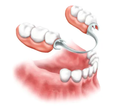 Съемные зубные протезы на имплантатах. Клиника профессора Абакарова