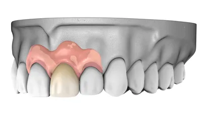 Полный съемный зубной протез в Москве: цена протезирования при полном  отсутствии зубов в стоматологии Лотус Дент