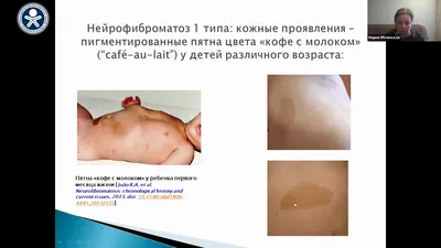 Кофейные пятна на коже | Советы дерматолога|Sovetydermatologa | Дзен