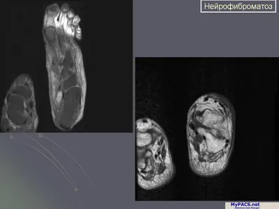 Микрофотография Показывающая Нейрофиброму Нейрофиброматоз Это Генетическое  Заболевание Генные Мутации — стоковые фотографии и другие картинки  Бангладеш - iStock