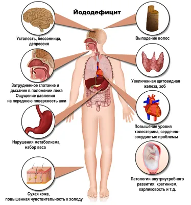Длительный недостаток йода может привести к развитию