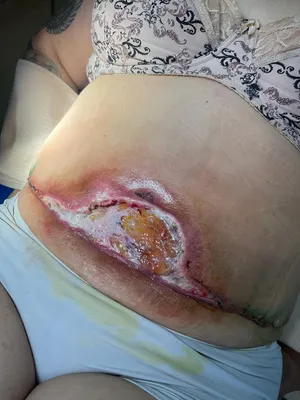 Начался некроз губ: три истории девушек, пострадавших от рук косметолога