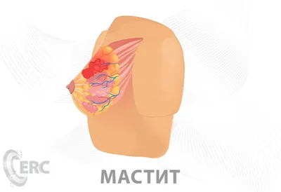 Симптомы мастита и способы его лечения — медицинские статьи Европейского  Радиологического Центра