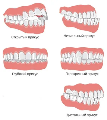 Неправильный прикус у ребенка: виды, причины и лечение - Underson Clinic
