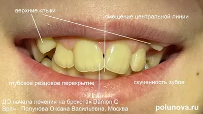 Что делать, если шатается молочный зуб | Купрум | Дзен