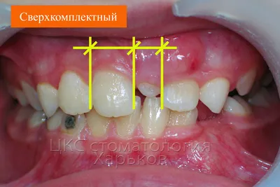 Скученность зубов - причины, признаки, степени, последствия, лечение