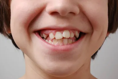 Неправильно растут зубы у ребенка фото