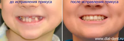 Коронки для временных зубов у детей | | Стоматология DENTAL-сервис г.Ковров  - лечение зубов, протезирование