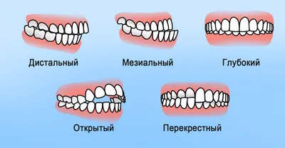 Растет зуб мудрости. Симптомы. Лечение. - блог «ДИНАСТИЯ»