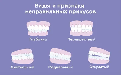 Как определить правильный и неправильный прикус: подробно о проблеме прикуса