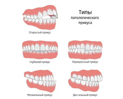 Правильный и неправильный прикус у детей: какие бывают виды, симптомы