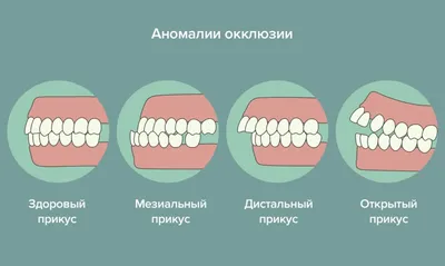 Неправильный прикус у пациента.