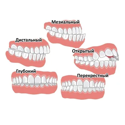 Как определить правильный или неправильный прикус зубов фото