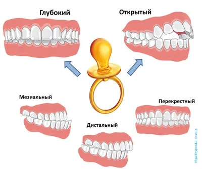 Виды прикуса - Cтоматология Май