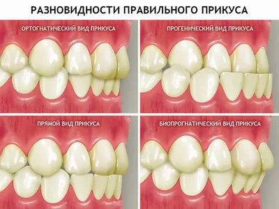 Неправильный прикус зубов виды и способы лечения в Минске, «Брекетлаб»