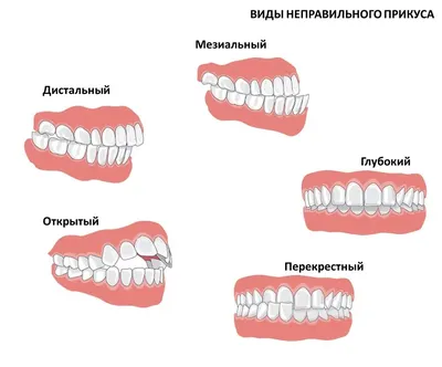 Face Smile Center - Чем грозит неправильный прикус? Речь, эстетика лица и  общее состояние здоровья ротовой полости пациента с неправильным прикусом  могут быть нарушены. Далеко не всегда прикус можно исправить с помощью