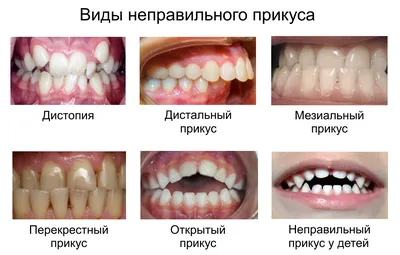 Неправильный Прикус У Ребенка Как Исправить ЛюмиДент