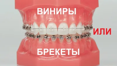 Неправильный прикус: причины возникновения, виды, последствия и коррекция