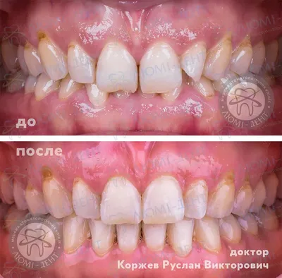 Всё и подробно про исправление прикуса - Доктор Стом