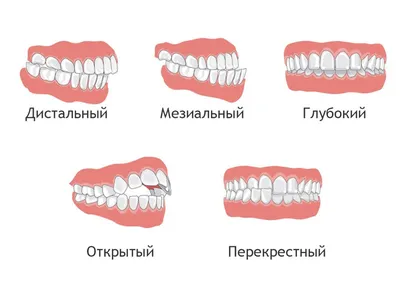 Неправильный прикус зубов — причины и последствия на Startsmile.ru