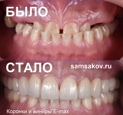 Влияние неправильного прикуса на форму лица - City Smile