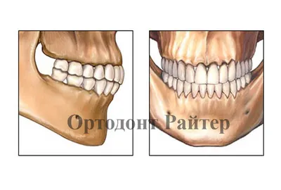Исправление прикуса, фото до и после, отзывы пациентов, ортогнатическая  хирургия, операция