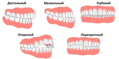 Коронки на зубах занизили прикус и разрушили другие зубы – клиника Smile  STD, Москва