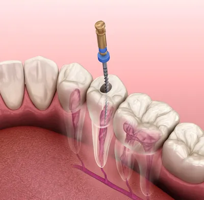 Удаление нерва зуба в Москве недорого, цены от Дантистофф